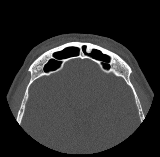 Acute sinusitis (Radiopaedia 23161-23215 Axial bone window 67).jpg