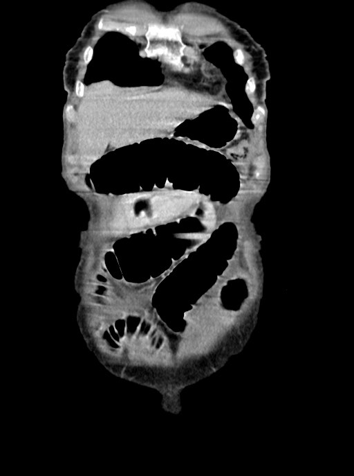 Acute small bowel (ileal) volvulus (Radiopaedia 71740-82139 Coronal C+ portal venous phase 17).jpg