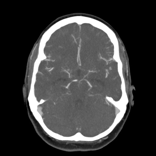 Acute subarachnoid hemorrhage and accessory anterior cerebral artery (Radiopaedia 69231-79009 D 27).jpg
