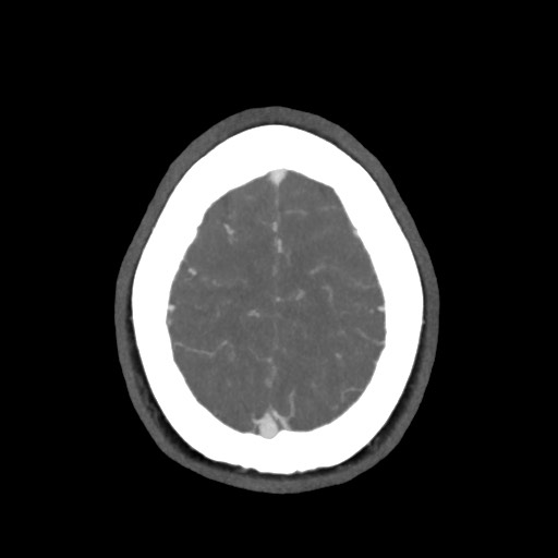 Acute subarachnoid hemorrhage and accessory anterior cerebral artery (Radiopaedia 69231-79009 D 60).jpg