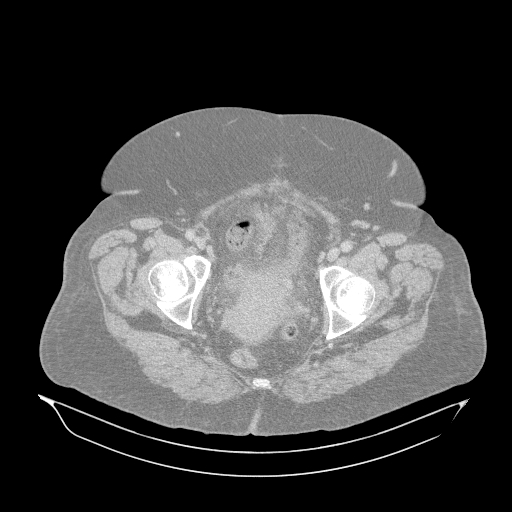 Acute superior mesenteric artery occlusion (Radiopaedia 51288-56960 Axial lung window 73).jpg