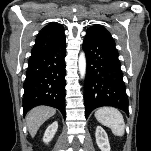 Adenocarcinoma of the lung (Radiopaedia 59871-67325 Coronal C+ arterial phase 54).jpg