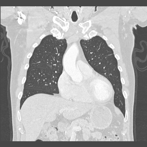 Adenocarcinoma of the lung (Radiopaedia 59871-67325 Coronal lung window 15).jpg