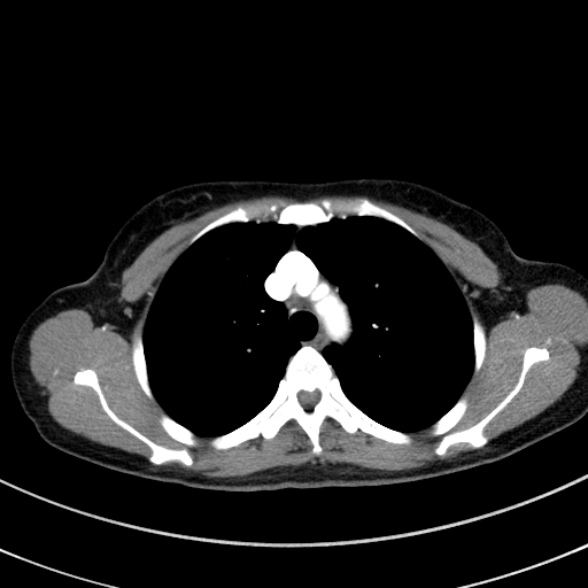 Adenocystic carcinoma of the trachea (Radiopaedia 47677-52525 Axial C+ arterial phase 40).jpg