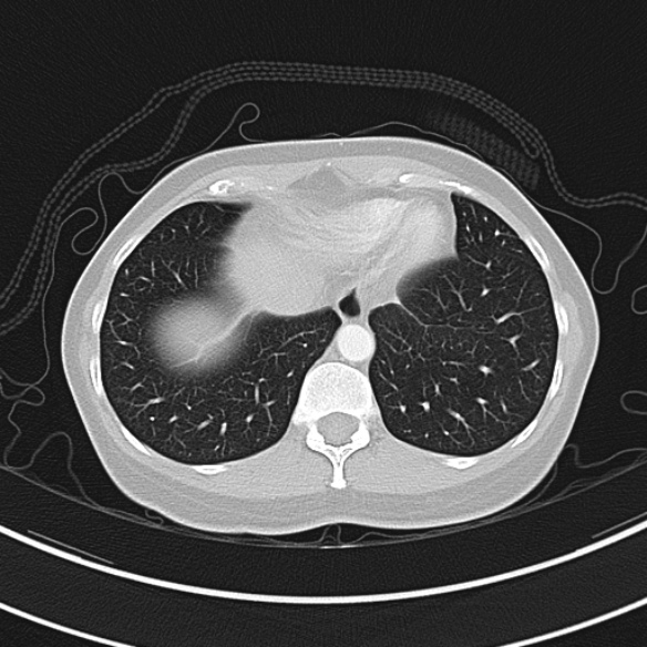 Adenocystic carcinoma of the trachea (Radiopaedia 47677-52525 Axial lung window 70).jpg