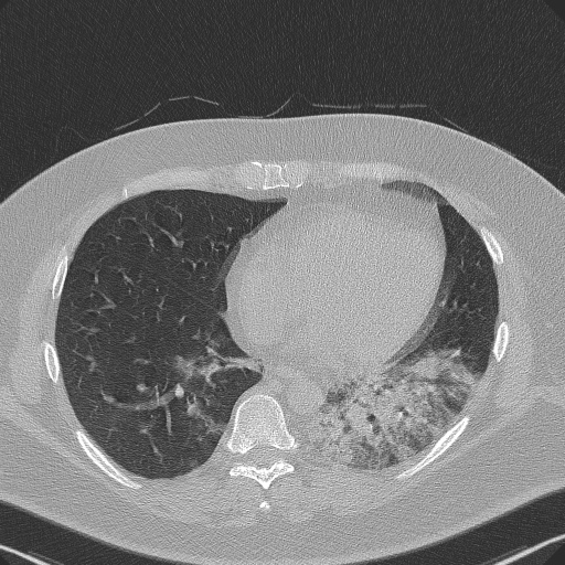 Adenoid cystic carcinoma of the trachea (Radiopaedia 49042-54137 Axial lung window 235).jpg
