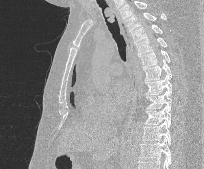 Adenoid cystic carcinoma of the trachea (Radiopaedia 49042-54137 Sagittal lung window 245).jpg
