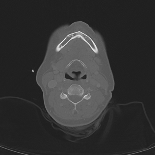 Adenoid cystic tumor of palate (Radiopaedia 46980-51518 Axial bone window 44).png