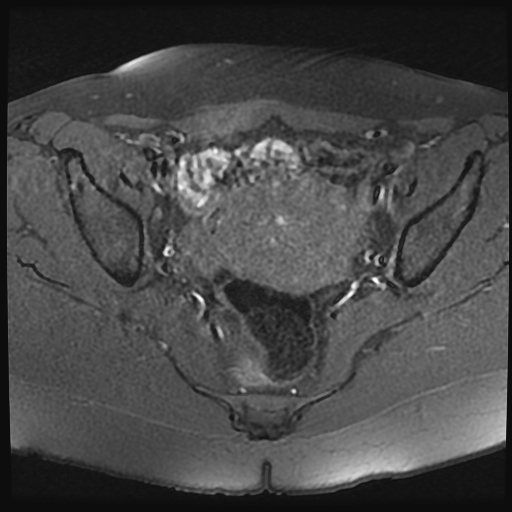 File:Adenomyosis-scar endometriosis (Radiopaedia 65863-75022 Axial T1 fat sat 14).jpg