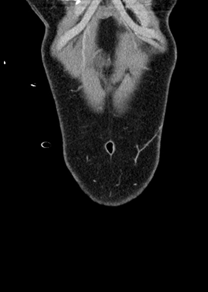 Adhesional small bowel obstruction (Radiopaedia 48397-53305 Coronal C+ portal venous phase 29).jpg