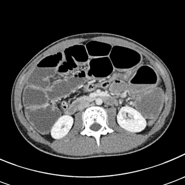 Adhesional small bowel obstruction (Radiopaedia 52107-57980 Axial C+ portal venous phase 51).jpg