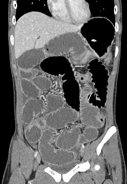 Adhesional small bowel obstruction (Radiopaedia 52107-57980 Coronal C+ portal venous phase 26).jpg