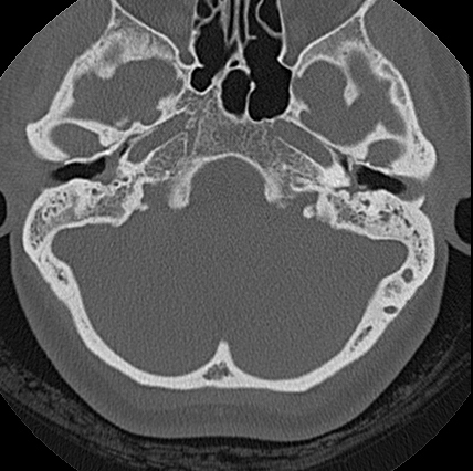 File:Adhesive chronic otitis media (Radiopaedia 14270-14148 Axial bone window 11).jpg