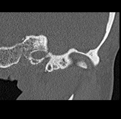 File:Adhesive chronic otitis media (Radiopaedia 14270-14148 Coronal bone window - left 3).jpg