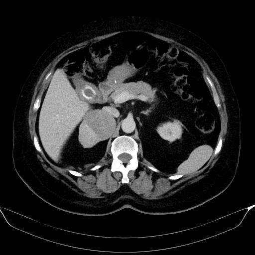 Adrenal cortical carcinoma (Radiopaedia 64017-72769 Axial C+ portal venous phase 22).jpg