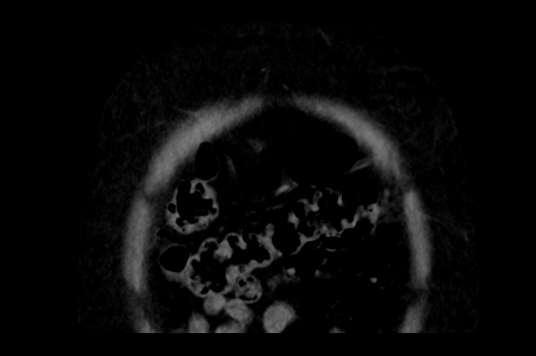 Adrenal cortical carcinoma (Radiopaedia 64017-72769 Coronal non-contrast 7).jpg