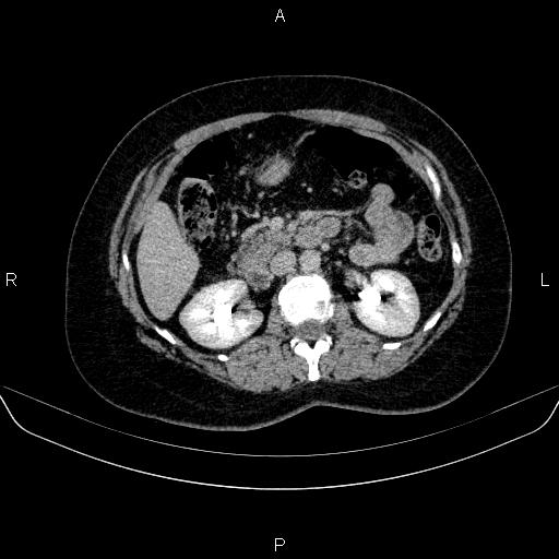 Adrenal cortical carcinoma (Radiopaedia 84882-100379 Axial C+ delayed 35).jpg