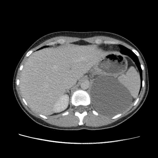 Adrenal cyst (Radiopaedia 64869-73813 Axial C+ portal venous phase 18).jpg