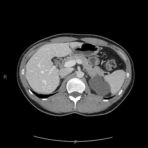 Adrenal cystic lymphangioma (Radiopaedia 83161-97534 Axial C+ portal venous phase 30).jpg