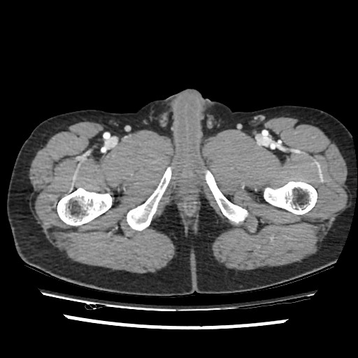 Adrenal gland trauma (Radiopaedia 81351-95078 Axial Dual bolus trauma C+ 128).jpg
