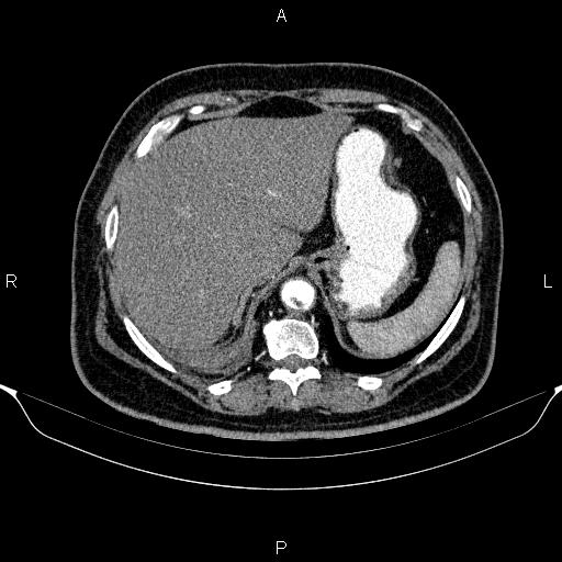 Adrenal hemorrhage (Radiopaedia 62622-70916 Axial C+ arterial phase 61).jpg
