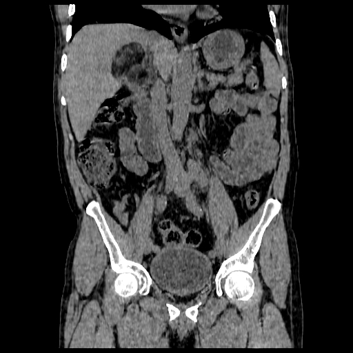 File:Adrenal myelolipoma (Radiopaedia 41843-44834 Coronal non-contrast 3).jpg