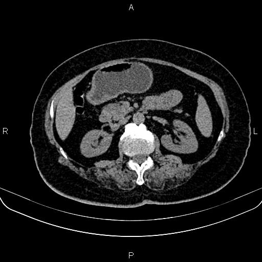 Adrenal myelolipoma (Radiopaedia 82742-96986 Axial non-contrast 65).jpg