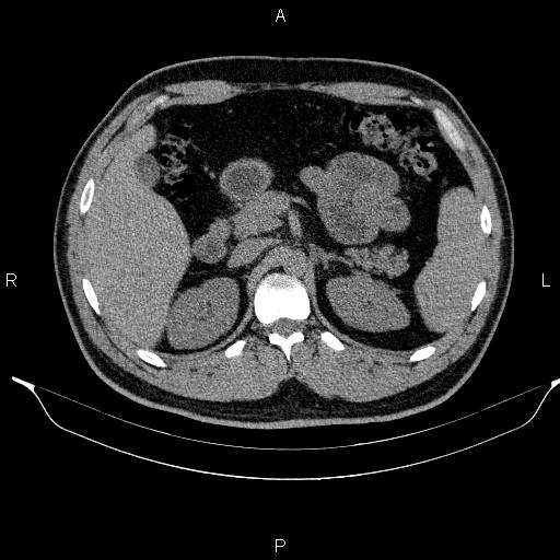 Adrenal myelolipoma (Radiopaedia 84321-99619 Axial non-contrast 38).jpg