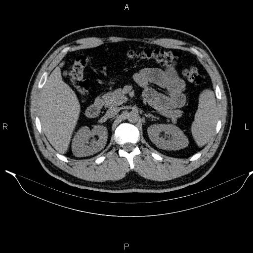 Adrenal myelolipoma (Radiopaedia 84321-99619 Axial non-contrast 40).jpg