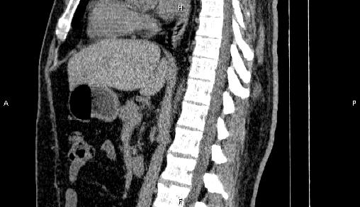 File:Adrenal myelolipoma (Radiopaedia 84321-99619 Sagittal non-contrast 55).jpg