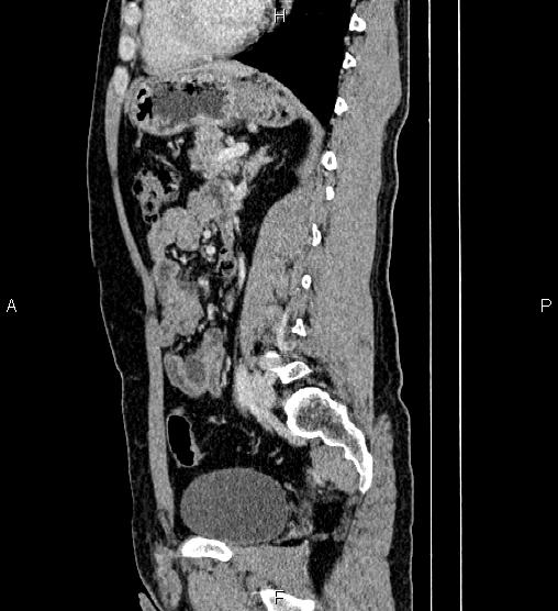Adrenal myelolipoma (Radiopaedia 87794-104246 Sagittal renal cortical phase 58).jpg