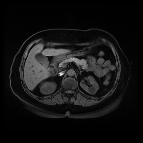 Adrenal myelolipoma - MRI (Radiopaedia 83249-97646 Axial T1 fat sat 33).jpg