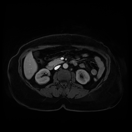 Adrenal myelolipoma - MRI (Radiopaedia 83249-97646 T1 fat sat arterial phase 50).jpg