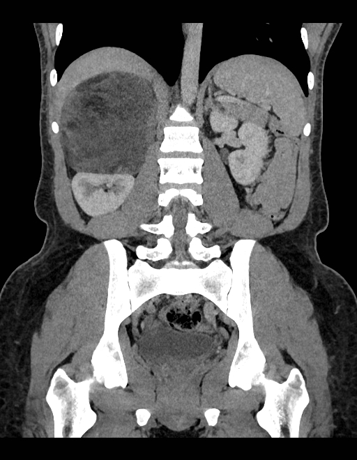 Adrenal myelolipoma - bilateral (Radiopaedia 74805-85810 Coronal C+ portal venous phase 123).jpg