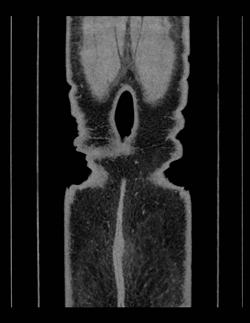 Adrenal myelolipoma - bilateral (Radiopaedia 74805-85810 Coronal C+ portal venous phase 34).jpg