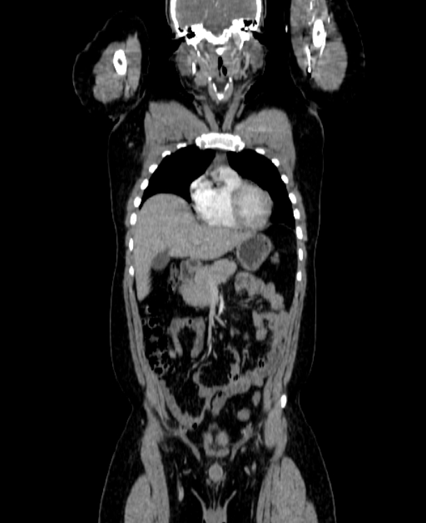 Adrenocortical carcinoma (Radiopaedia 80134-93438 Coronal C+ portal venous phase 56).jpg