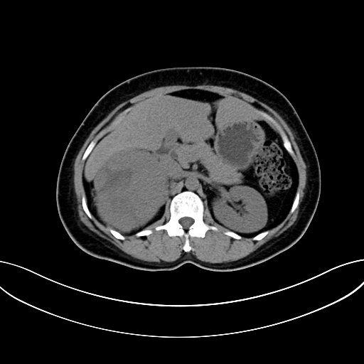 Adrenocortical carcinoma (Radiopaedia 87281-103569 Axial non-contrast 33).jpg