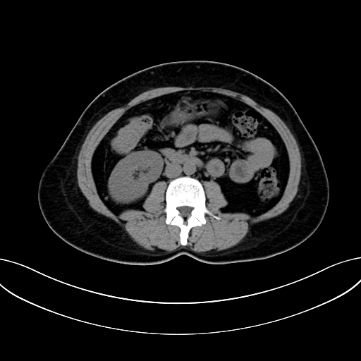 Adrenocortical carcinoma (Radiopaedia 87281-103569 Axial non-contrast 45).jpg