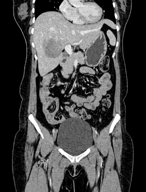 Adrenocortical carcinoma (Radiopaedia 87281-103569 Coronal C+ portal venous phase 11).jpg