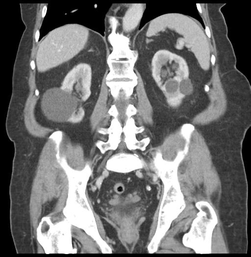 Adult ileal intussusception with secondary obstruction (Radiopaedia 30395-31051 Coronal C+ portal venous phase 43).jpg