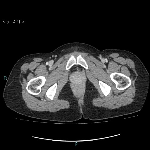 File:Adult transient intestinal intussusception (Radiopaedia 34853-36310 Axial C+ portal venous phase 128).jpg