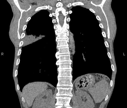 Air bronchogram in pneumonia (Radiopaedia 85719-101512 Coronal non-contrast 44).jpg