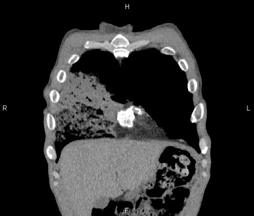 Air bronchogram in pneumonia (Radiopaedia 85719-101512 Coronal non-contrast 7).jpg