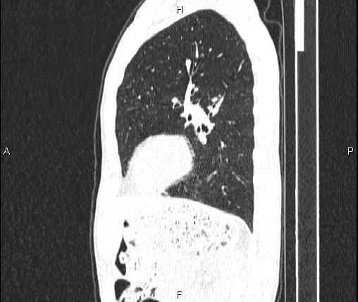 Air bronchogram in pneumonia (Radiopaedia 85719-101512 Sagittal lung window 69).jpg