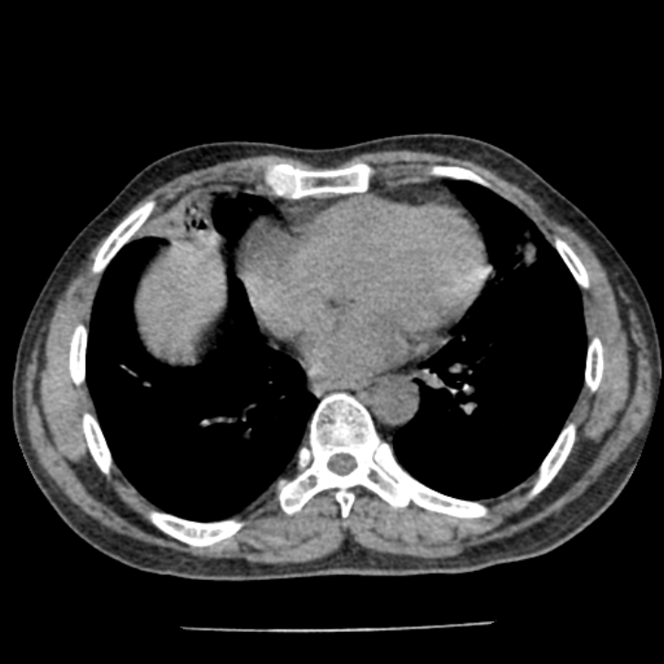 Airway foreign body in adult (Radiopaedia 85907-101779 Axial liver window 123).jpg