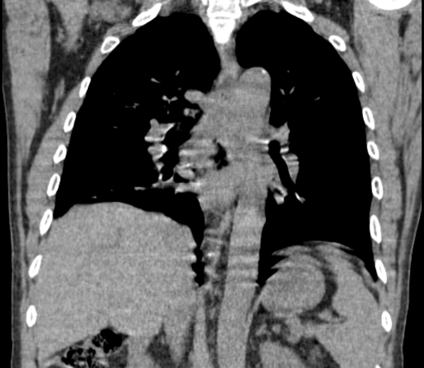 Airway foreign body in adult (Radiopaedia 85907-101779 Coronal liver window 166).jpg