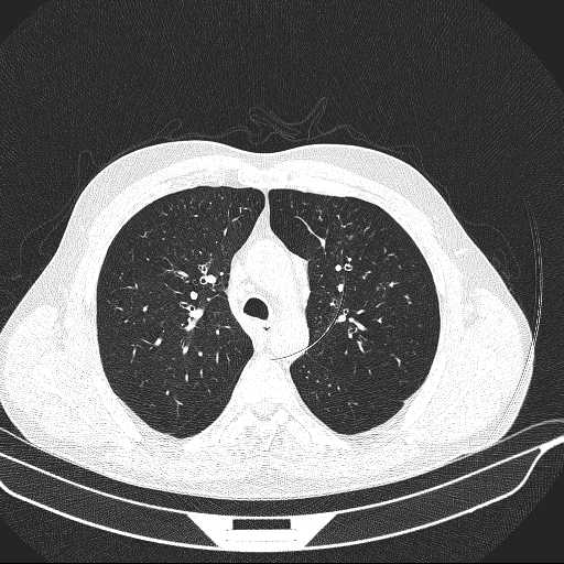 File:Allergic bronchopulmonary aspergillosis (Radiopaedia 21386-21320 Axial lung window 12).jpg