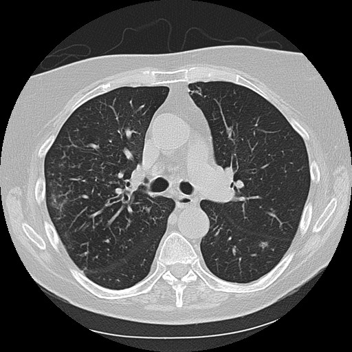 Alpha-1-antitrypsin deficiency (Radiopaedia 72058-82557 Axial lung window 29).jpg