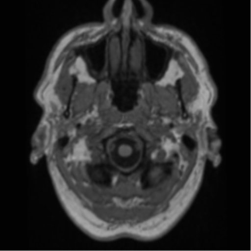 File:Alzheimer's disease- with Gerstmann syndrome and dressing apraxia (Radiopaedia 54882-61150 Axial T1 3).png