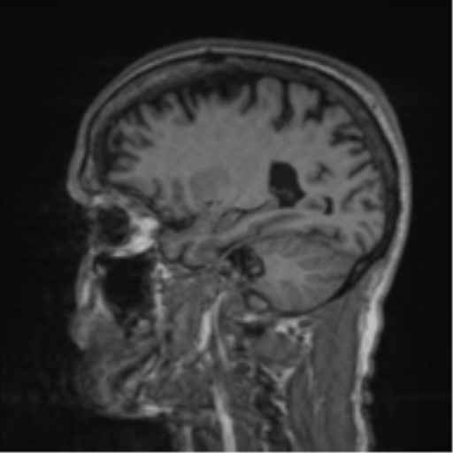 File:Alzheimer's disease- with apraxia (Radiopaedia 54763-61011 Sagittal T1 48).png
